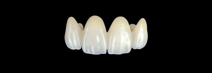 Cerameus PMMA temporaries crown-bridges