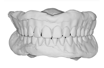 Digitaler Zahnersatz Scan the denture(s) inside out