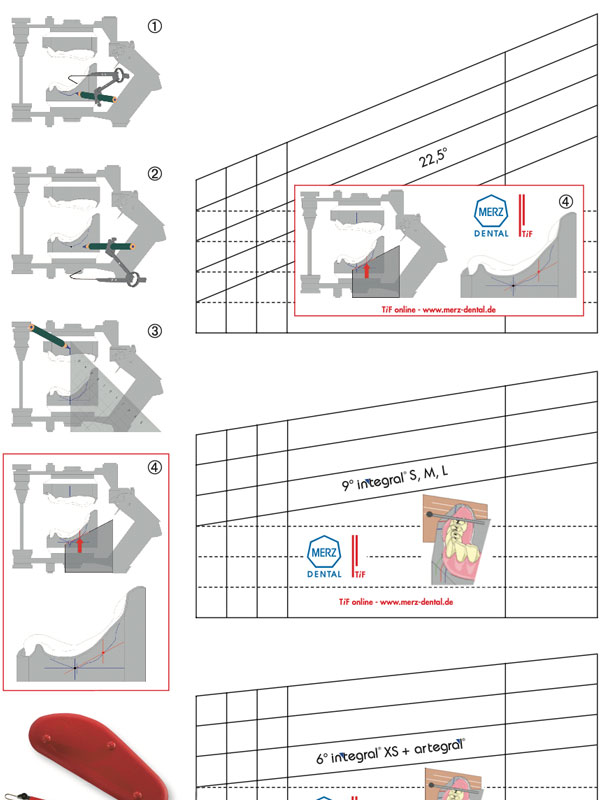 digitaler Zahnersatz