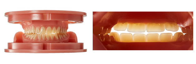 Digitaler Zahnersatz Abrasion-Resistant