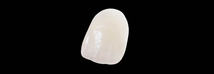 Cerameus Porcelain bonded crown-bridges