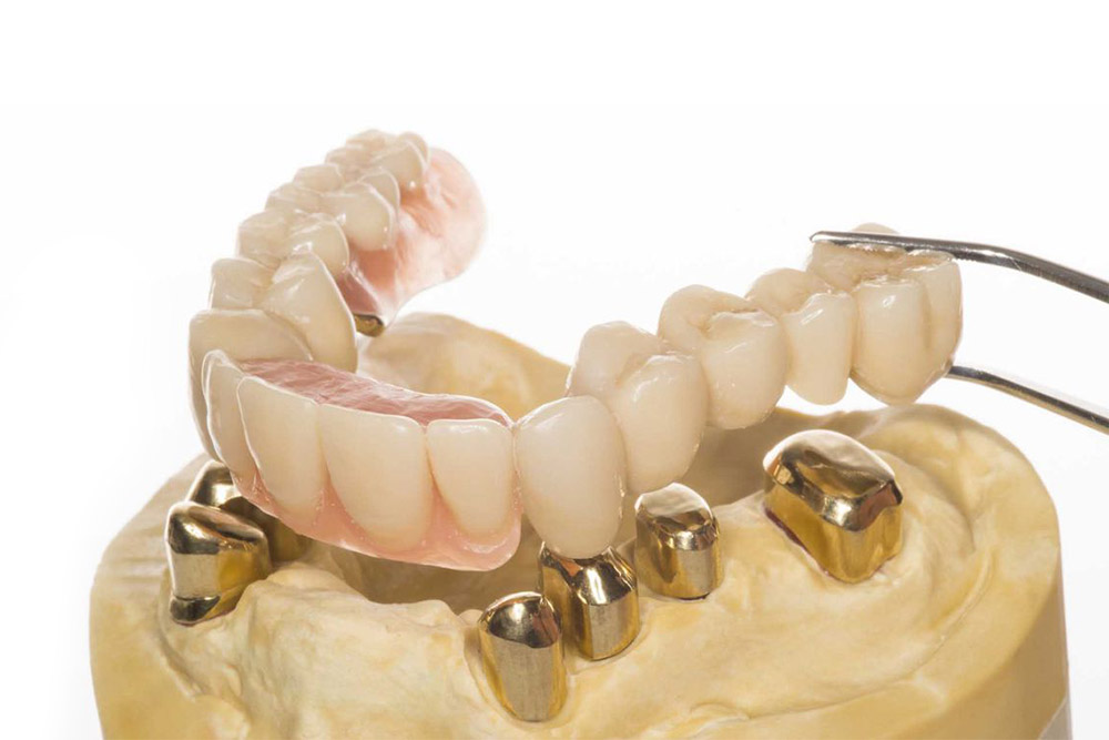 Cerameus Denture